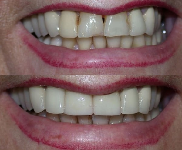 affordable dental implants in astoria