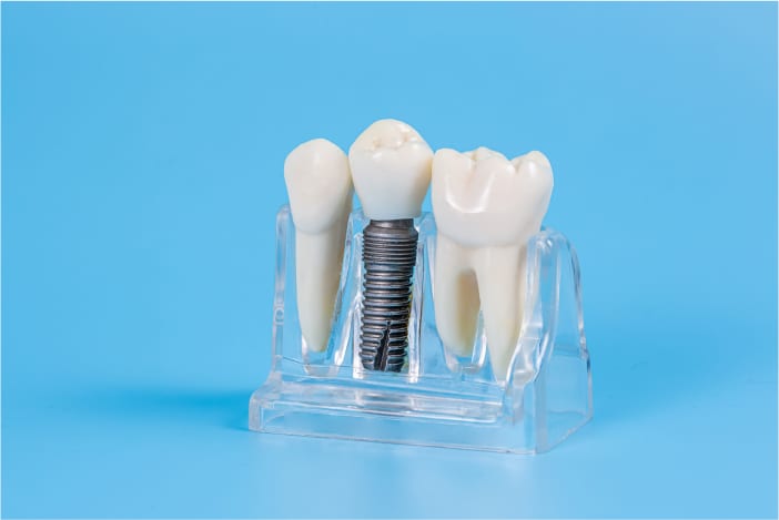 affordable dental implants in Astoria